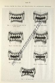 Ludwig Beckmann, Abrasion of the fangs and incisors